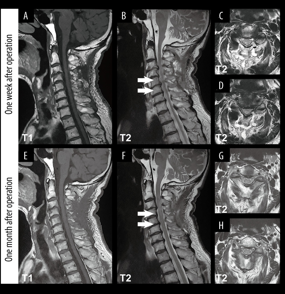 Cervical magnetic resonance imaging (MRI) after operation. (A–D) One week after the operation, the high-signal intensity area was significantly reduced on T2-weighted MRI compared with before surgery (limited to C3–C6 vertebral levels, arrows). (E–H) One month after the operation, the high-signal intensity area was further reduced on T2-weighted MRI compared with 1 week after the operation (limited to C3-C4 vertebral levels, arrows).