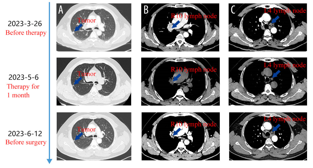 Timeline of CT examinations before surgery. (A) On the first CT before therapy, a solid nodule was found in the right upper lobe, measuring approximately 10×9 mm, with irregular margins. Enlarged R10 and L4 lymph nodes were also found in the mediastinum. (B) One month after neoadjuvant therapies, CT showed decreased size of the nodule beneath the pleura (from 10×9 mm to 5×4 mm) and reduced size of R10 and L4 lymph nodes. (C) Two months after neoadjuvant therapies but before surgery, CT showed the nodule beneath the pleura had remained the same size (5×4 mm) and the lymph node had decreased in size (from 28×18 mm to 17×16 mm).