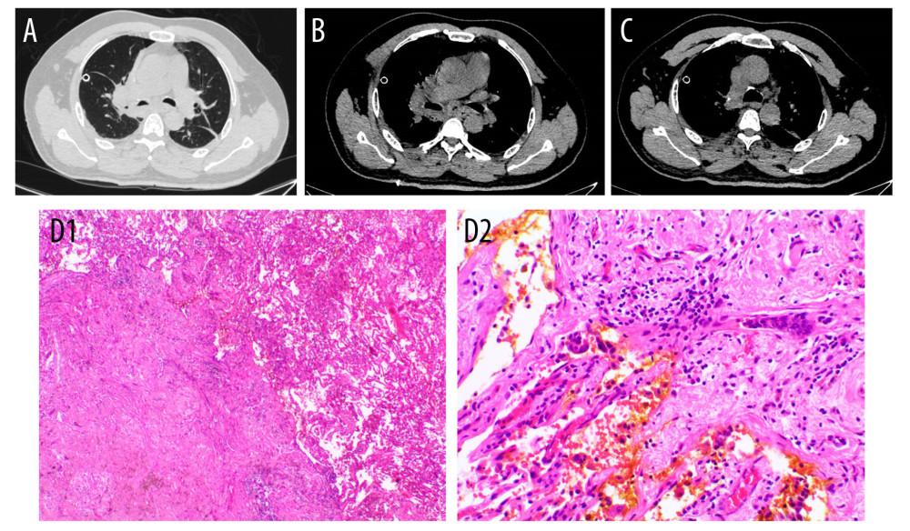 Evaluation after the surgery. (A–C) CT image of chest after surgery. (D) HE stain of right upper lung showed interstitial fibrous tissue proliferation accompanied by chronic inflammatory cell infiltration, hemosiderin deposition, and aggregation of tissue cells within the pulmonary alveoli. No residual tumor was observed.