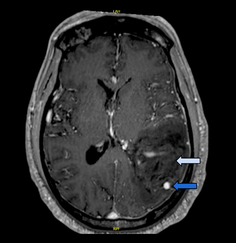 Axial view of a magnetic resonance imaging of the brain with gadolinium contrast (T1 Post) showing a 5-mm pseudoaneurysm in the M4 parietal branch of the middle cerebral artery (dark blue arrow) and surrounding vasogenic edema (light blue arrow).