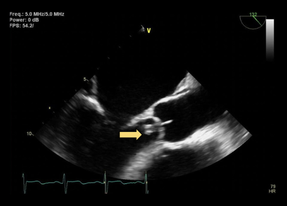 Transesophageal echocardiogram image of the aortic valve in the mid-esophageal long-axis view. The yellow arrow denotes the vegetation on the aortic valve.