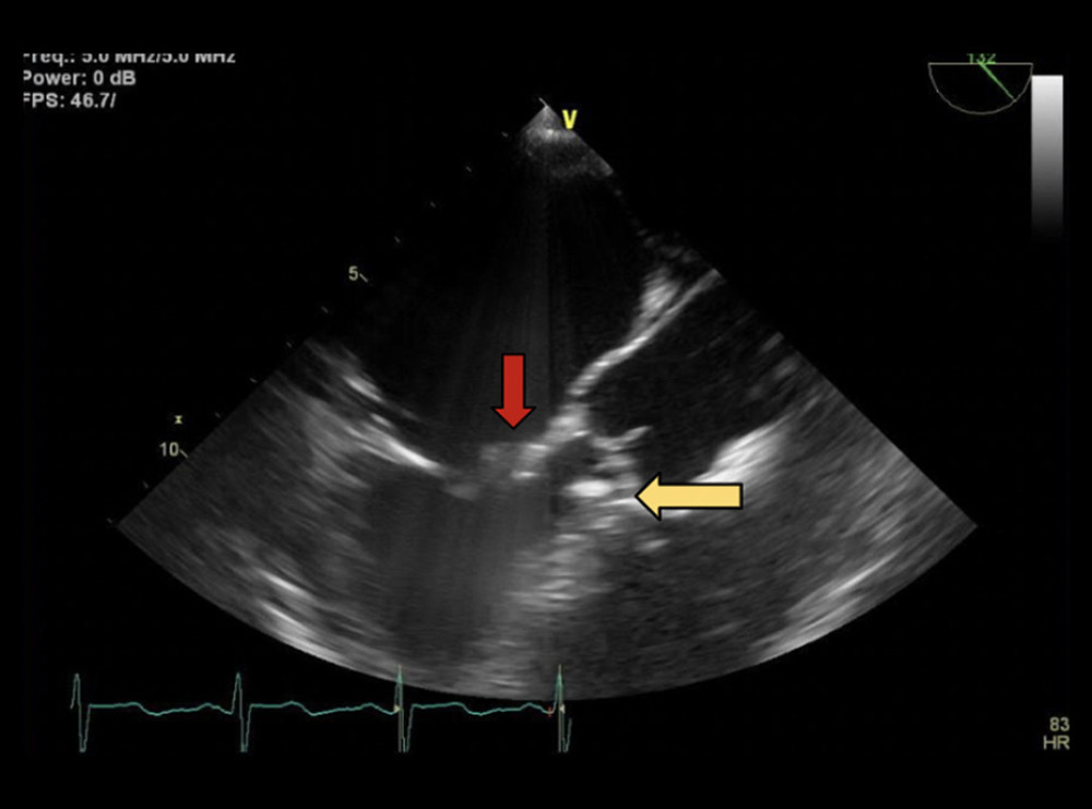 Transesophageal echocardiogram image of the aortic and mitral valves in the mid-esophageal aortic long axis view. The yellow arrow denotes the vegetation on the aortic valve; the red arrow denotes the vegetation on the mitral valve.