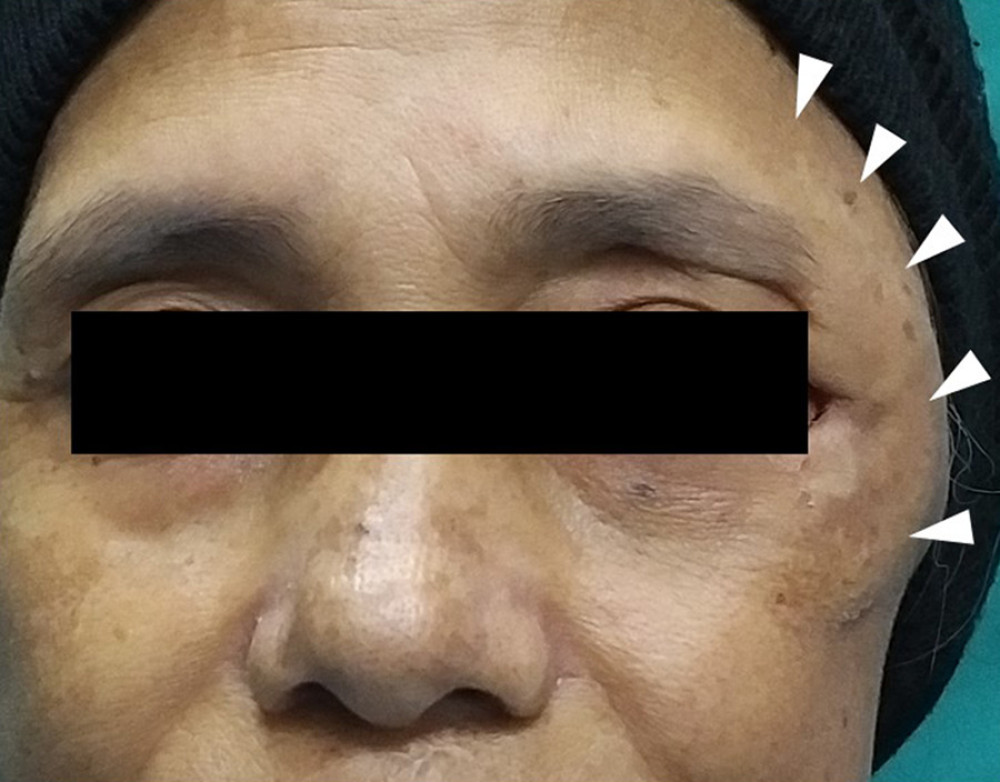 Clinical photograph showing asymmetry of the face. The upper part of the left cheek including the left fronto-zygomatic area appeared to be enlarged (white arrows).
