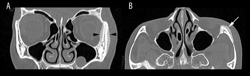 Bone algorithm computed tomography of the facial bones at presentation, in (A) coronal and (B) axial orthogonal planes, demonstrating solid elevated periosteal reaction at the left zygomatic bone and anterior aspect of left zygomatic arch (black arrowheads in A, white arrow in B). Incidental finding of bilateral concha bullosa was noted.