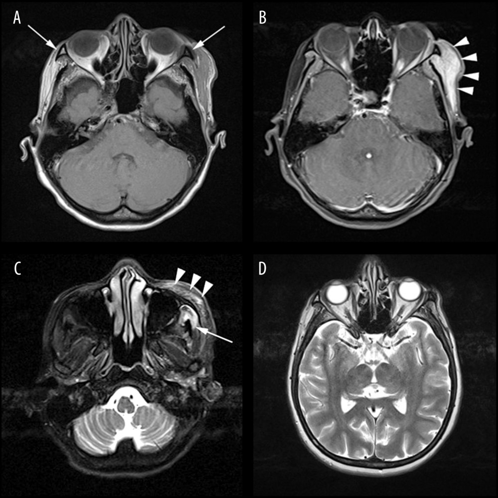 (A) Initial axial T1-weighted magnetic resonance imaging (MRI), (B) fat-suppressed after gadolinium contrast, and (C) fat-suppressed T2-weighted sequences. (D) Subsequent follow-up MRI in T2-weighted sequence is also exhibited. T1 lengthening of marrow signal within left zygomatic bone is shown (arrows in A point toward bilateral zygomatic bones for comparison), indicating fatty marrow replacement. There is enhancing periosteal reaction surrounding the left zygomatic bone, which can be seen to extend minimally into the extraconal fat of adjacent left orbit. The left lateral rectus muscle returns normal signal intensities. No subperiosteal abscess is detected within the orbit. The left temporalis muscle and fascia appear swollen, returning a hyperintense signal at T2-weighted sequence (arrow in C) and enhanced after gadolinium. Note also the surrounding subcutaneous fat stranding at the left premaxillary space (arrowheads in C) and enhancement of subcutaneous fat overlying said temporal muscle (arrowheads in B). (D) Subsequent follow-up MRI shows resolution of the T2 altered signal demonstrated by the left temporalis muscle.