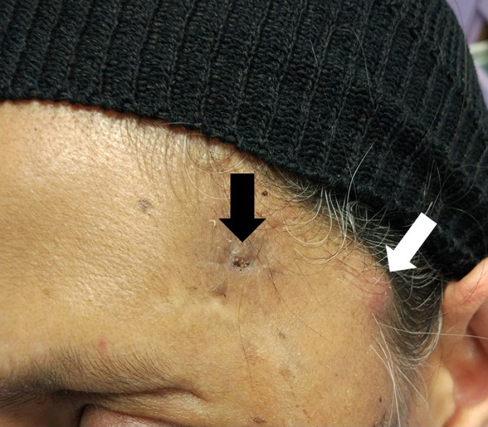 Clinical photograph showing the left side of upper part of the face. There was a scar (black arrow) from the previous procedure. The white arrow shows a new fluctuant swelling.