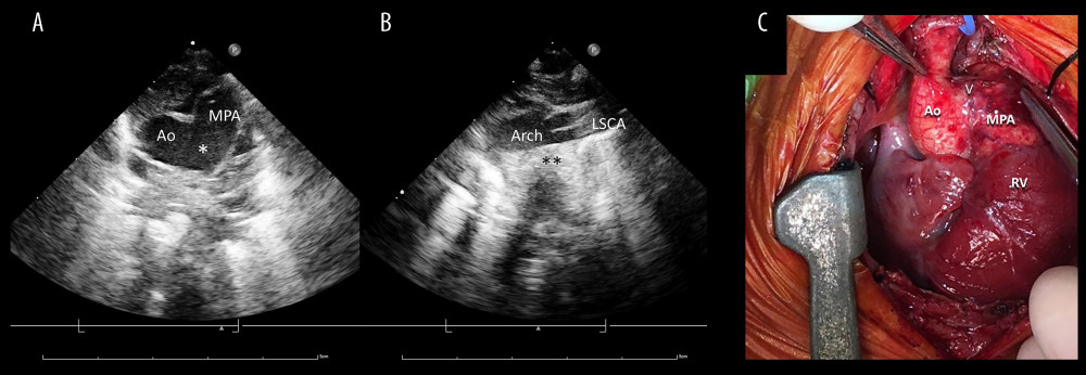 (A) Transthoracic echocardiogram shows aortopulmonary window type I (*) between the ascending aorta (Ao) and main pulmonary artery (MPA), forming the “heart-shaped” great vessels. (B) Echocardiography shows interrupted aortic arch (**) after left subclavian artery (LSCA), indicating IAA type A. (C) Surgical photography shows aortopulmonary window (V) between the ascending aorta (Ao) and main pulmonary artery (MPA). Arch – aortic arch; RV – right ventricle.