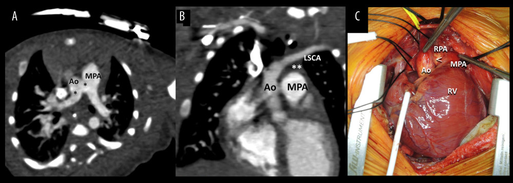 (A) Computed tomography shows APW type III (*) between right pulmonary artery and ascending aorta, forming the “W” shaped communication between great vessels. (B) Computed tomography shows the interrupted aortic arch (**) after left subclavian artery (LSCA), which indicated IAA type A. (C) Surgical photography shows APW type III (<) behind the ascending aorta (Ao) and anterior to right pulmonary artery (RPA). There was no communication between main pulmonary artery (MPA) and ascending aorta (Ao). Ao – ascending aorta; MPA – main pulmonary artery; RV – right ventricle.
