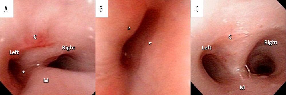 Bronchoscopy on postoperative day (POD) 7 and POD 66. (A) Expiratory phase, POD 7, compression of left main bronchus (*) and intrusion (<50%) of posterior membrane (M). (B) POD 7, bronchoscopy advanced into left main bronchus. Arrowheads (> and <) denote external compression of the left main bronchus. (C) Expiratory phase, POD 66, resolution of left main bronchus obstruction. C – cartilage part of trachea; M – membranous part of trachea.