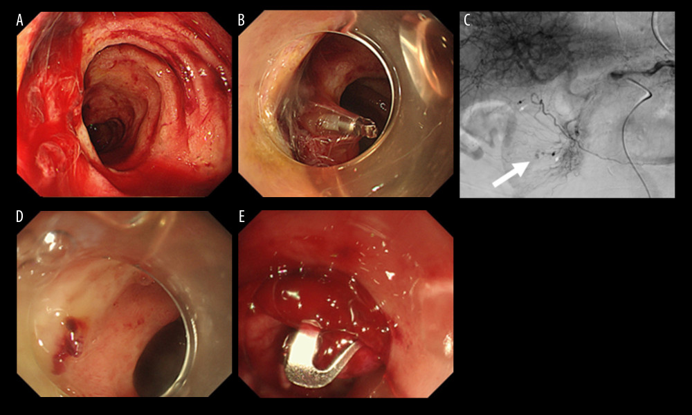 An endoscopic examination was performed the next day as a second-look procedure, and gushing bleeding was found in the inner part of the duodenum (A). We performed hemostasis with a clip and the local injection of 2 ml of hypertonic saline epinephrine solution (B). On hospital day 3, celiac angiography revealed extravasation at the periphery of the gastroduodenal artery (indicated by arrow), and we performed embolization with two 2 mm×4 cm interlocking detachable coils (IDCs) (C). On hospital day 11, we attempted endoscopic hemostasis of the ulcer with exposed blood vessels (D). We achieved hemostasis using an over-the-scope clip (OTSC) (E).