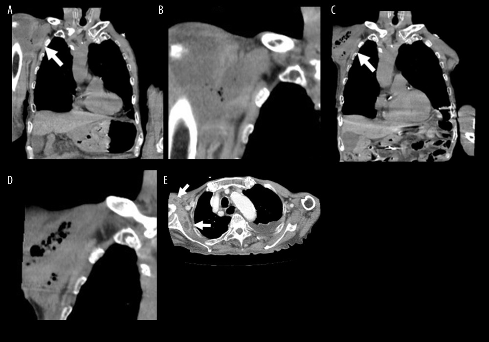 Computed tomography (CT) revealed severe swelling of the subcutaneous tissue, including a fluid component that was suspected of being pus, in the right upper arm (arrow and enlarged image of this region) on hospital day 3 (A, B). The soft tissue with the fluid component suspected of being pus in the right upper arm (arrow and enlarged image of this region) included gas on hospital day 23 (C, D). Contrast-enhanced CT revealed fluid collections that were suspected of being abscesses around the right shoulder joint (arrow) on hospital day 46, although the gas image had disappeared (E).