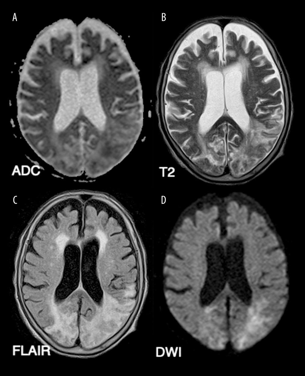 Brain magnetic resonance imaging revealed hyperintense lesions with elevated apparent diffusion coefficient (ADC) values (A) on T2-weighted imaging (T2WI) (B), fluid-attenuated inversion recovery (FLAIR) imaging (C), and diffusion-weight imaging (DWI) (D).