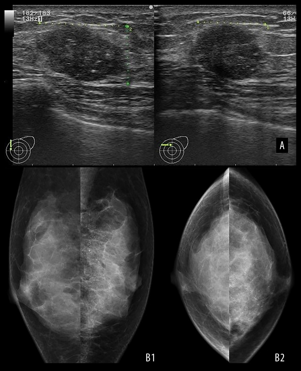 Image findings. (A) Breast ultrasonography revealed an irregularly shaped mass measuring 2.2×1.7×1.4 cm with an inhomogeneous inside and punctate high-echo contents. (B) Mammography showing pleomorphic calcifications spreading segmentary in the upper-inner quadrant of the left breast. (B1: MLO, B2: CC)