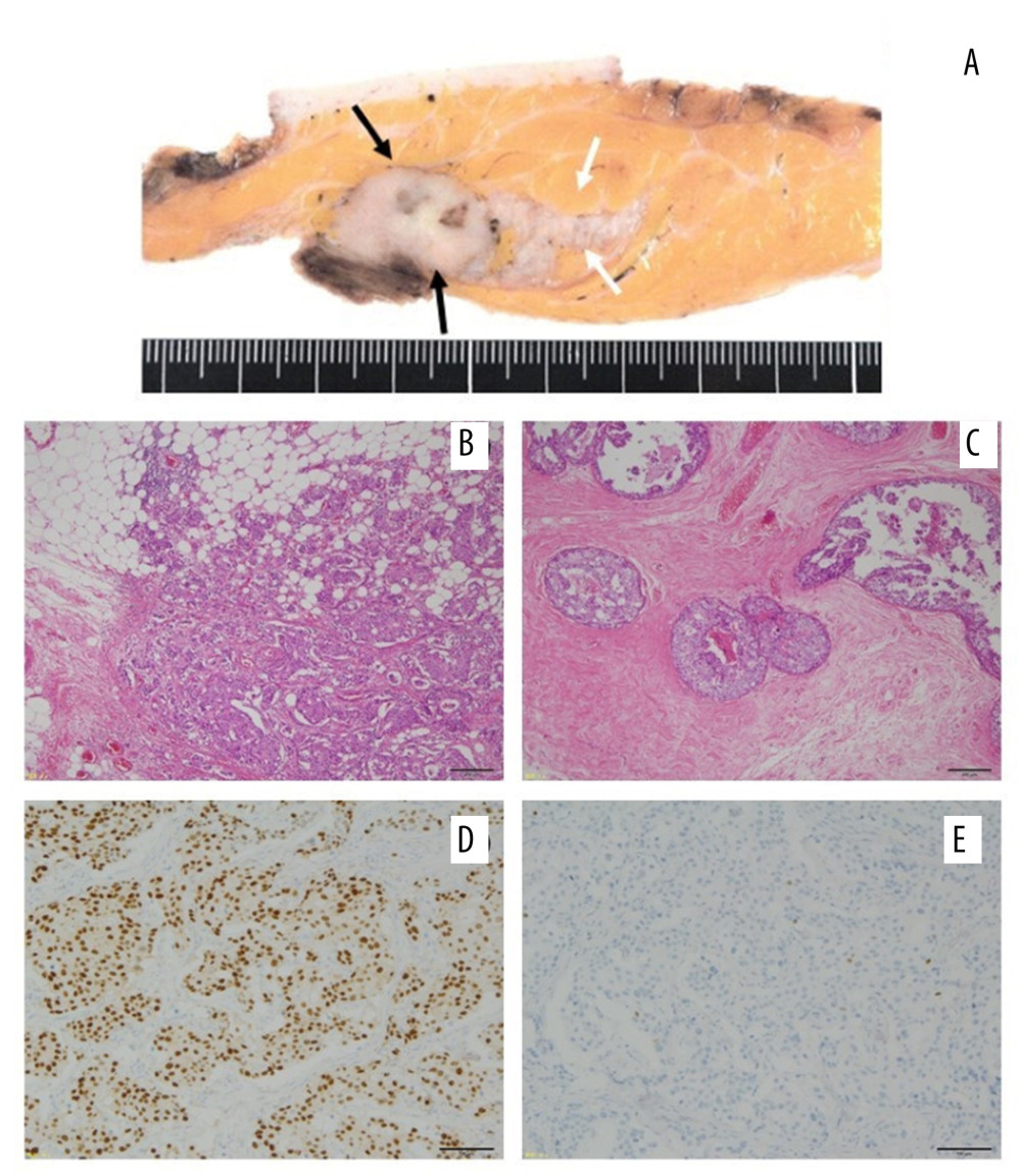 Histopathological findings. (A) Macroscopic image; (B) hematoxylin and eosin staining ×40; (C) hematoxylin and eosin staining ×40; (D) estrogen receptor staining; (E) progesterone receptor staining. (A) Macroscopically, the tumor was a well-defined, solid mass measuring 2.5×2.2 cm in size (black arrows) with wide extension in the direction of the left papillary side (white arrow). Microscopic findings revealing (B) invasive ductal carcinoma with (C) wide intraductal spreading. The tumor cells are strongly positive for (D) estrogen receptors and (E) almost negative for progesterone receptors.