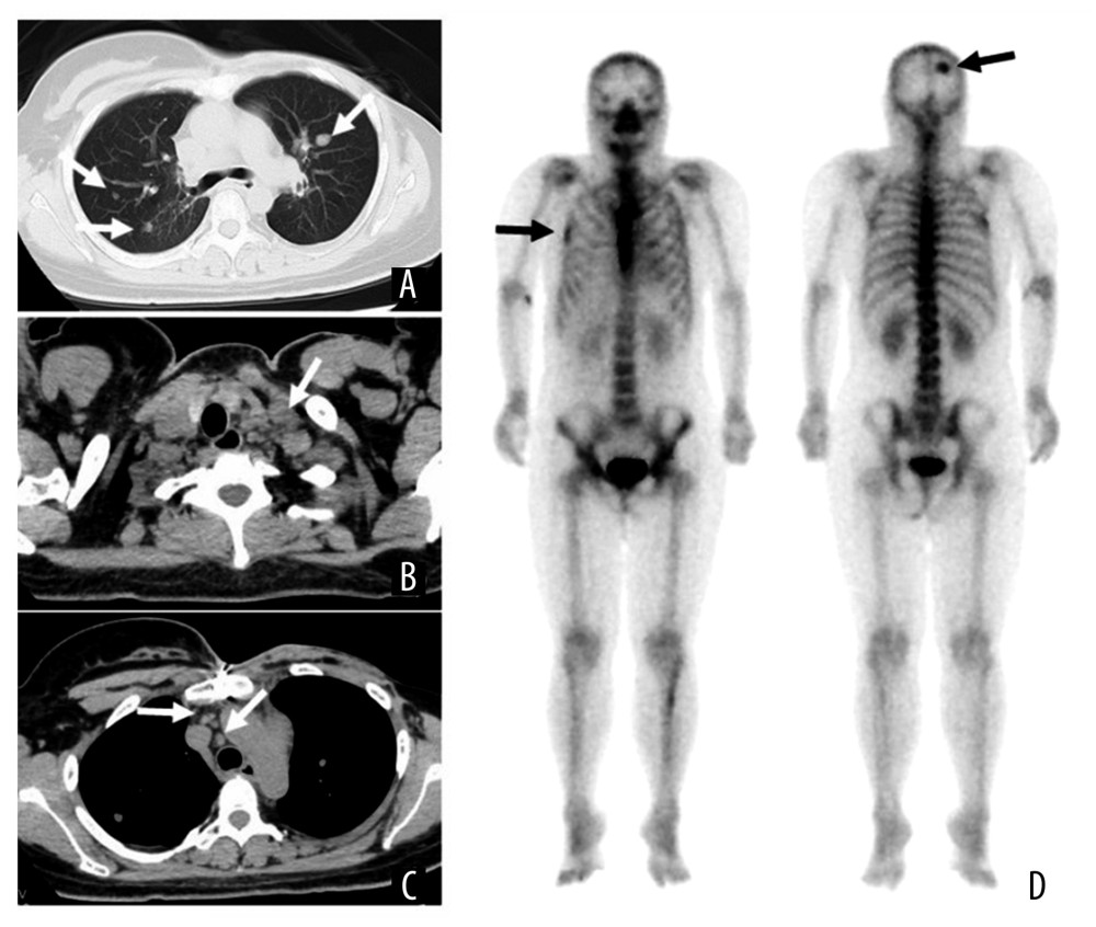 Image findings. (A–C) Cervicothoracic computed tomography (CT) examination; (D) bone scintigraphy; (A) CT revealing multiple lung metastases (white arrow); (B) left supraclavicular lymph node metastases multiple lymph node metastases left supraclavicular lymph node (white arrow); (C) mediastinal lymph node (white arrow); (D) bone scintigraphy showed skull and right 5th ribs (black arrow).
