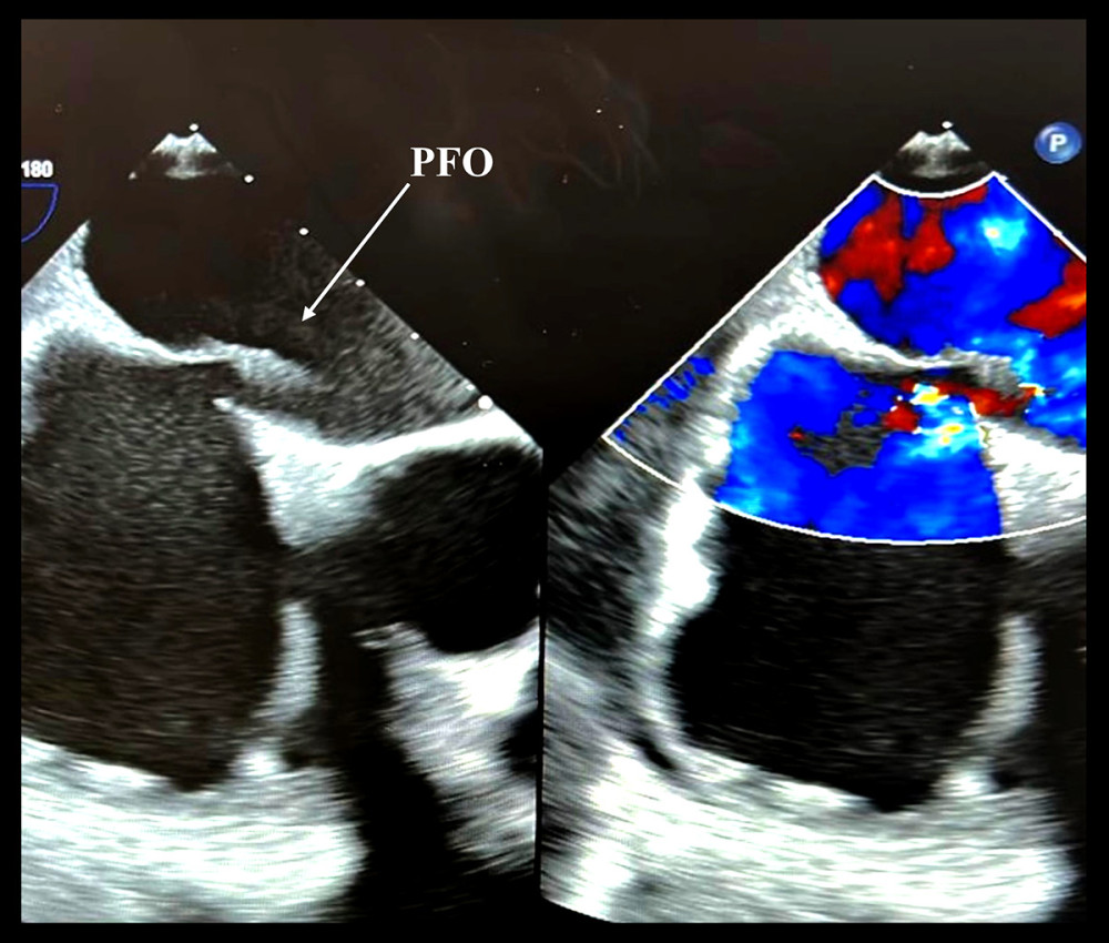 Transesophageal echocardiography modified zoomed view at 0 degrees showing PFO with echo color Doppler defect.