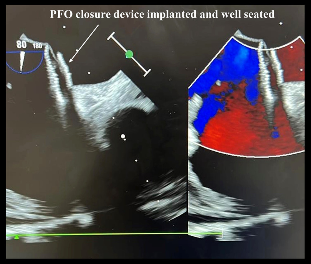Transesophageal echocardiograph short axis at 80 degrees showing septostomy and insertion of the patent foramen ovale closure device.