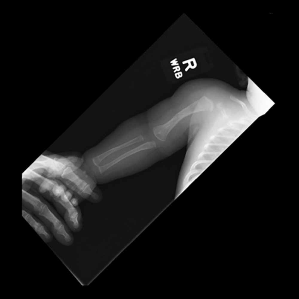 X-ray image of the right humerus fracture. The humeral fracture was a simple mid-shaft, non-displaced, non-spiral, with slight bowing.