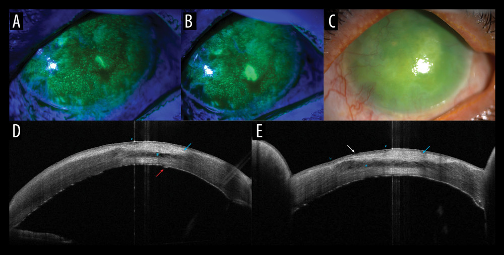 Slit lamp photos of the left eye at presentation. (A, B) Fluorescein-stained cornea with cobalt blue filter showing severe superficial punctate keratitis (diffuse corneal staining), a small epithelial defect and a paracentral leakage. (C) Fluorescein-stained cornea without cobalt blue filter showing diffuse corneal scarring with peripheral neovascularization. (D, E) Anterior segment optical coherence tomography showing anterior stromal scarring (hyper-reflectivity, blue arrow), intrastromal fluid collection (lacuna) (hypo-reflectivity, asterisk), epithelial bullae (arrowheads), possible entry site at an area of internal Descemet’s membrane discontinuity (red arrow), and an exit through an area of epithelial surface disruption (white arrow).