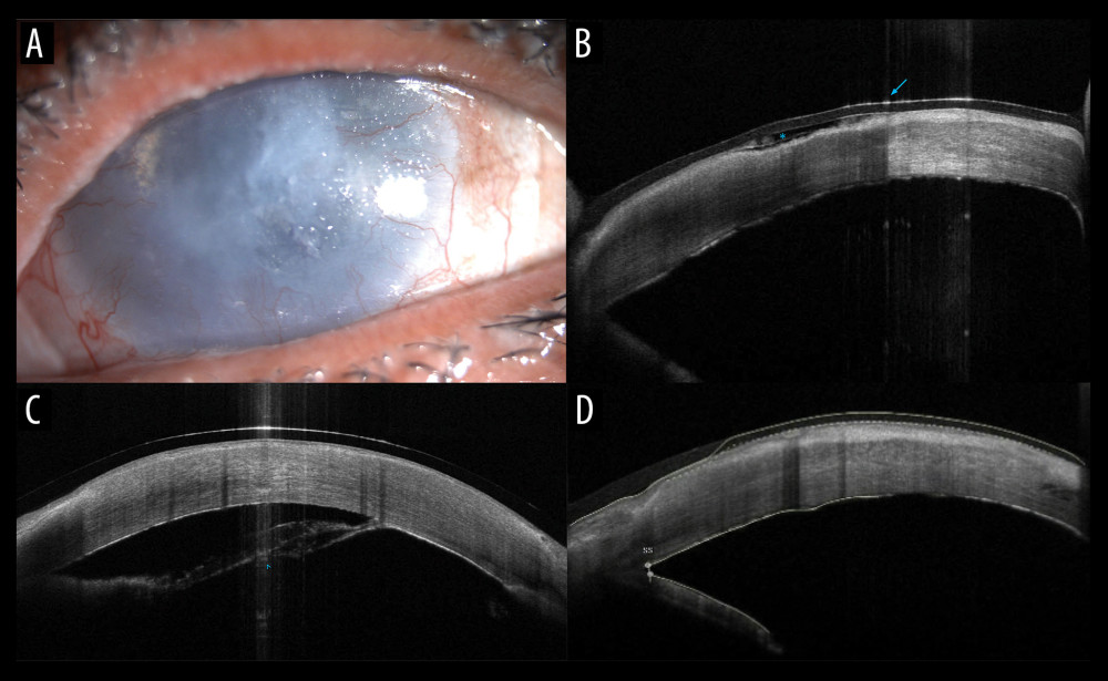 Day 1 after gluing. (A) Slit lamp photo showing diffuse corneal scarring and a thin layer of glue at the site of leakage. (B) Anterior segment optical coherence tomography (AS-OCT) showing a thin hyperreflective band corresponding to the glue (asterisk) under the outermost hyperreflective layer representing the bandage contact lens (blue arrow). Eight weeks after gluing. (C) AS-OCT showing an area of large central Descemet’s membrane (DM) detachment with resolution of internal tissue edema and disappearance of intrastromal fluid pockets. Twelve weeks after gluing. (D) AS-OCT reveals spontaneous reattachment of DM.