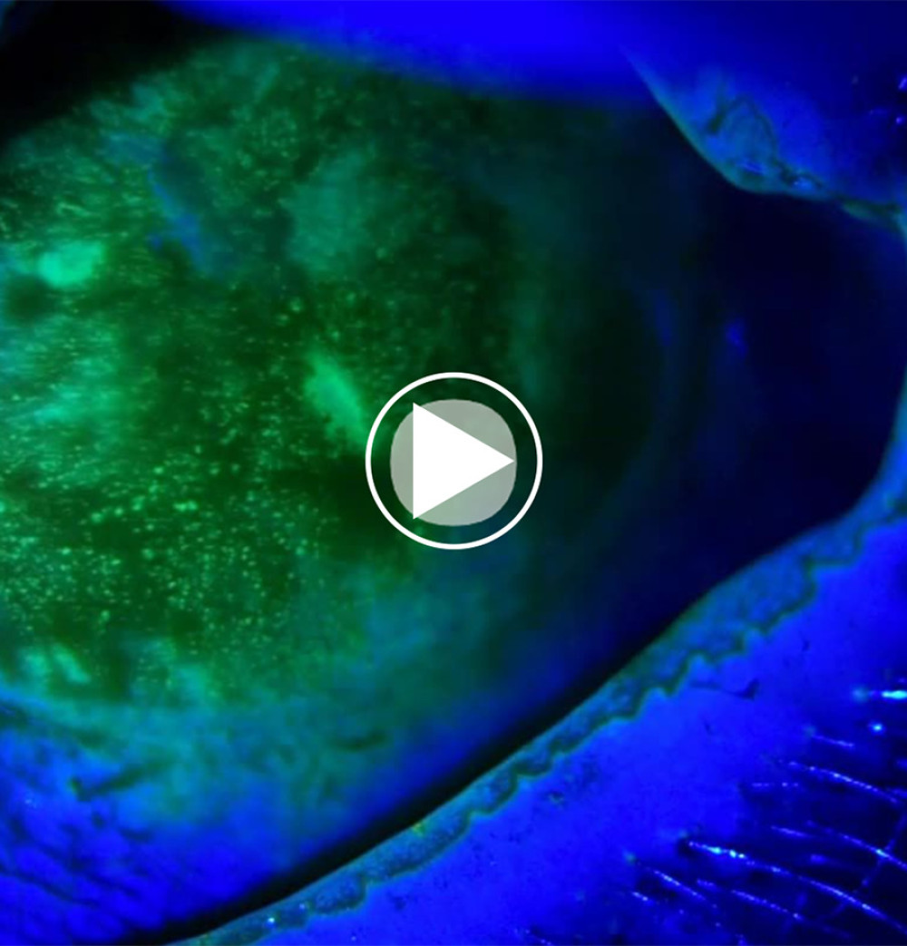 Fluorescein-stained cornea with cobalt blue filter holding the lids, showing superficial punctate keratitis and a paracentral area of slowly appearing, spontaneous, pinpoint corneal leak.