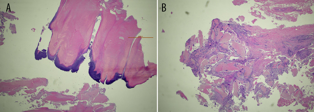 (A, B) Histopathology of the tumor confirmed the lesion was a pilomatrixoma. Low-power photomicrograph of the histopathology of a vaccination site-associated benign pilomatrixoma in a 65-year-old man. Fragments of dermal tissue include basaloid cells (dark blue) derived from the hair follicle that forms the cyst wall. The pilomatrixoma contains acellular keratin (pink). There is a granulomatous inflammatory response to keratin but no acute inflammation or abscess formation. Hematoxylin and eosin (H&E). Magnification ×20.