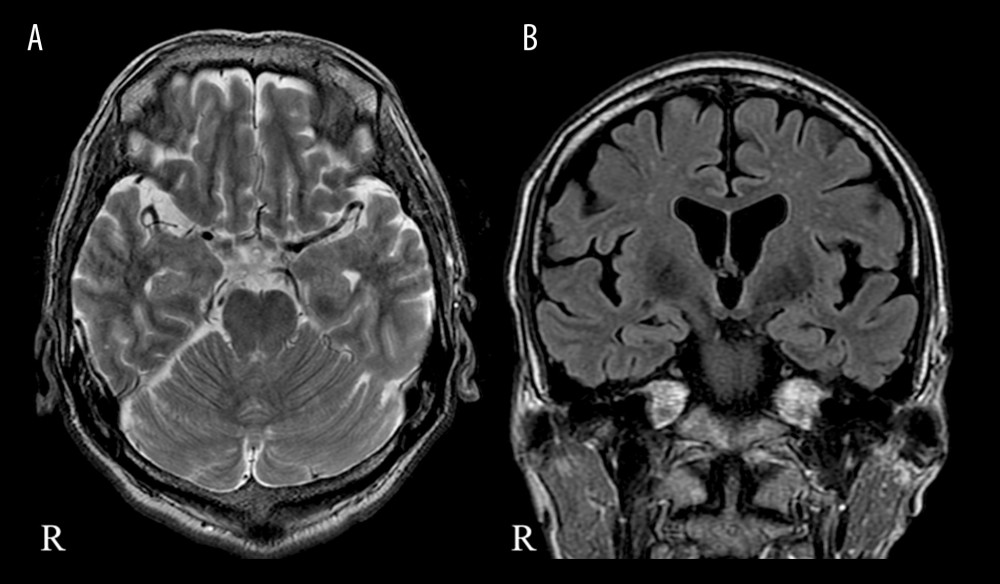 Magnetic resonance images (MRI) of the brain without contrast agent on admission. (A) Axial T2>-weighted MRI of the brain without contrast agent. (B) Coronal fluid-attenuated inversion-recovery (FLAIR) MRI of the brain without contrast agent. These images show no significant abnormal signal intensity in the brainstem, limbic system, and cortex.