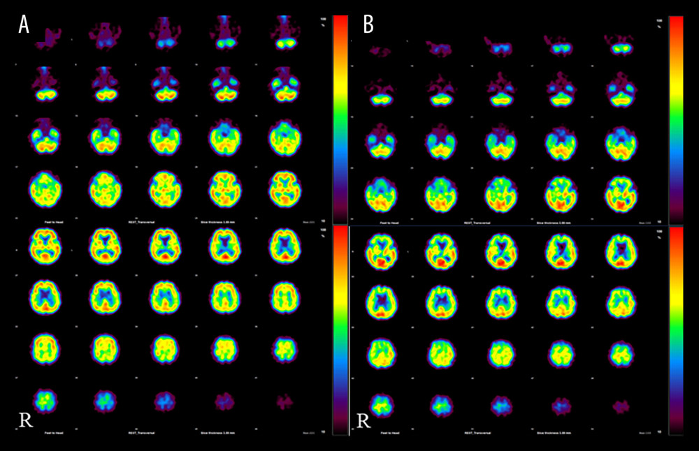 Cerebral blood flow (I−123)-iodoamphetamine single-photon emission computed tomography (SPECT) before and after steroid therapy. Panel (A) was taken in the acute phase of the disease without steroid treatment. Panel (B) was taken after 5 months when his symptoms had already improved. In comparison with Panel (B) retrospectively, Panel (A) suggests extensive cerebral hyperperfusion, including the brainstem and frontal and medial temporal lobes.
