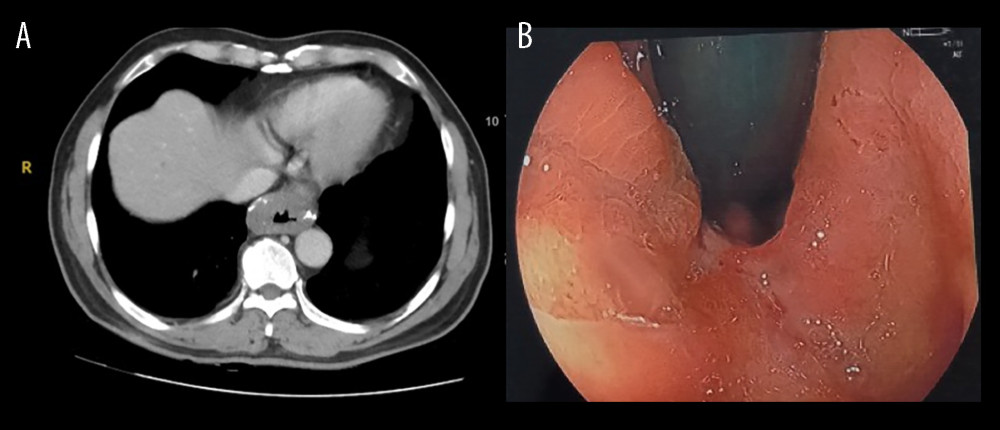 (A, B) Lesion of esophageal leiomyoma on computed tomography scan and endoscopy.