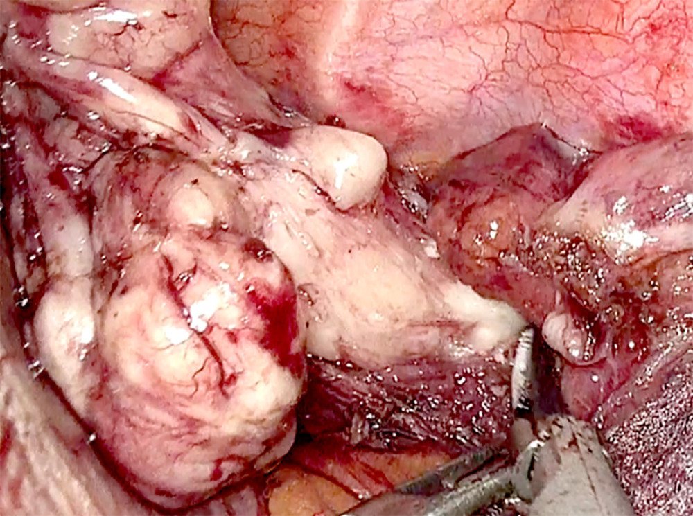 Macroscopic image of the lower esophageal tumor.