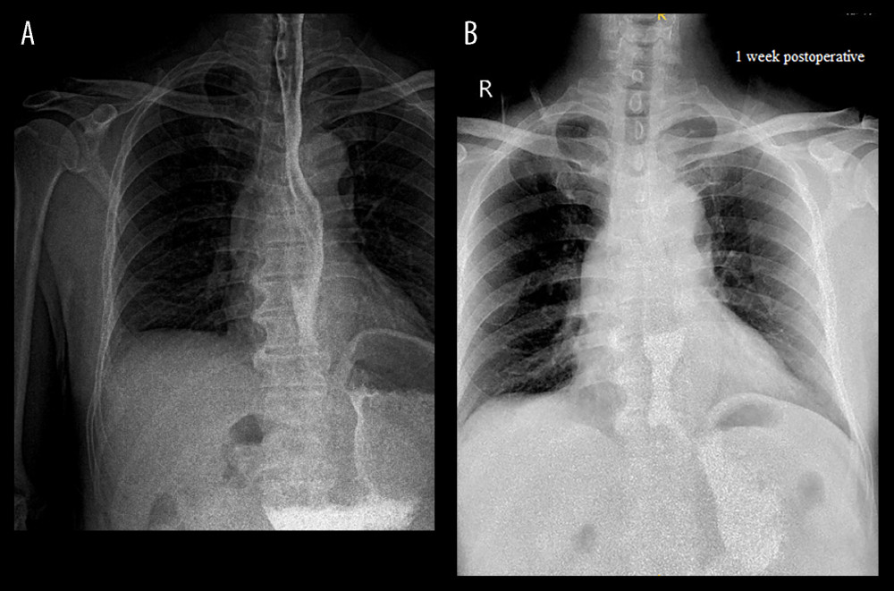 Esophagogram at (A) 1 month and (B) 1 week after surgery.