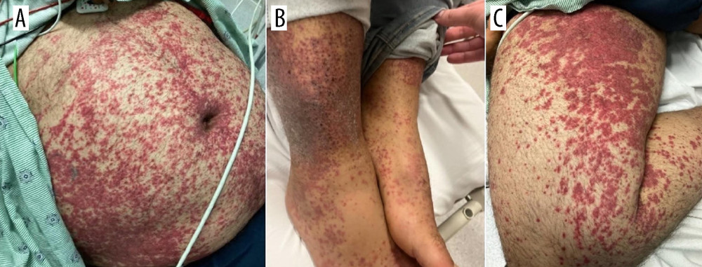 Skin findings on patient presentation in the hospital. (A) Abdomen with many scattered, non-blanching purpuric papules and macules ranging from bright pink to violaceous in color. (B) The patient’s ankles with non-blanching purpuric papules and macules. (C) Medial aspect of lower extremity with purpuric rash