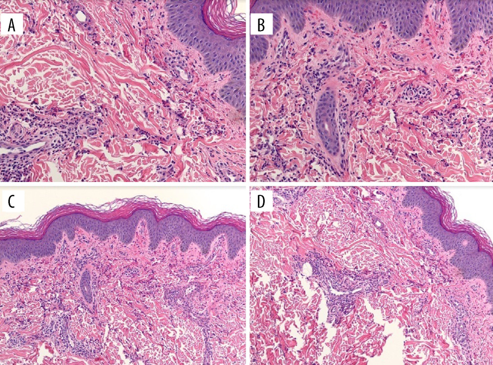 (A–D) Skin biopsy of purpuric lesions which demonstrate IgA vasculitis, showing a typical finding in skin, with leukocytoclastic vasculitis. Prominent inflammatory infiltrate including neutrophils was present in the dermal capillaries, and marked, extravasated red blood cells were seen in the dermis.