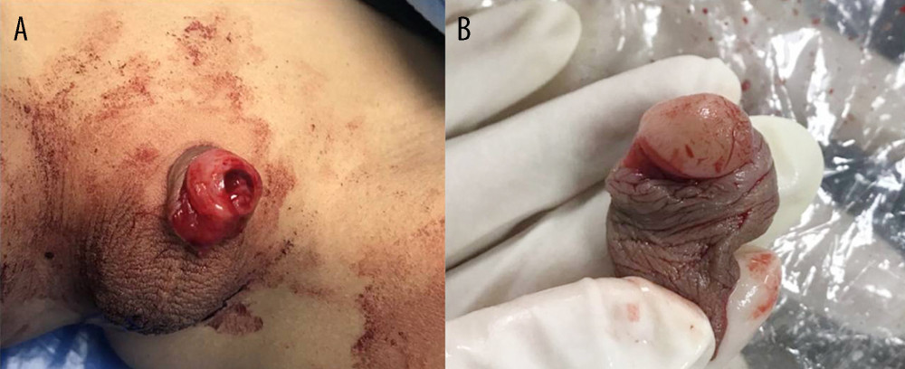 Degree of penile injury after ritual circumcision. (A) Injured penile stump; (B) Amputated tissue.