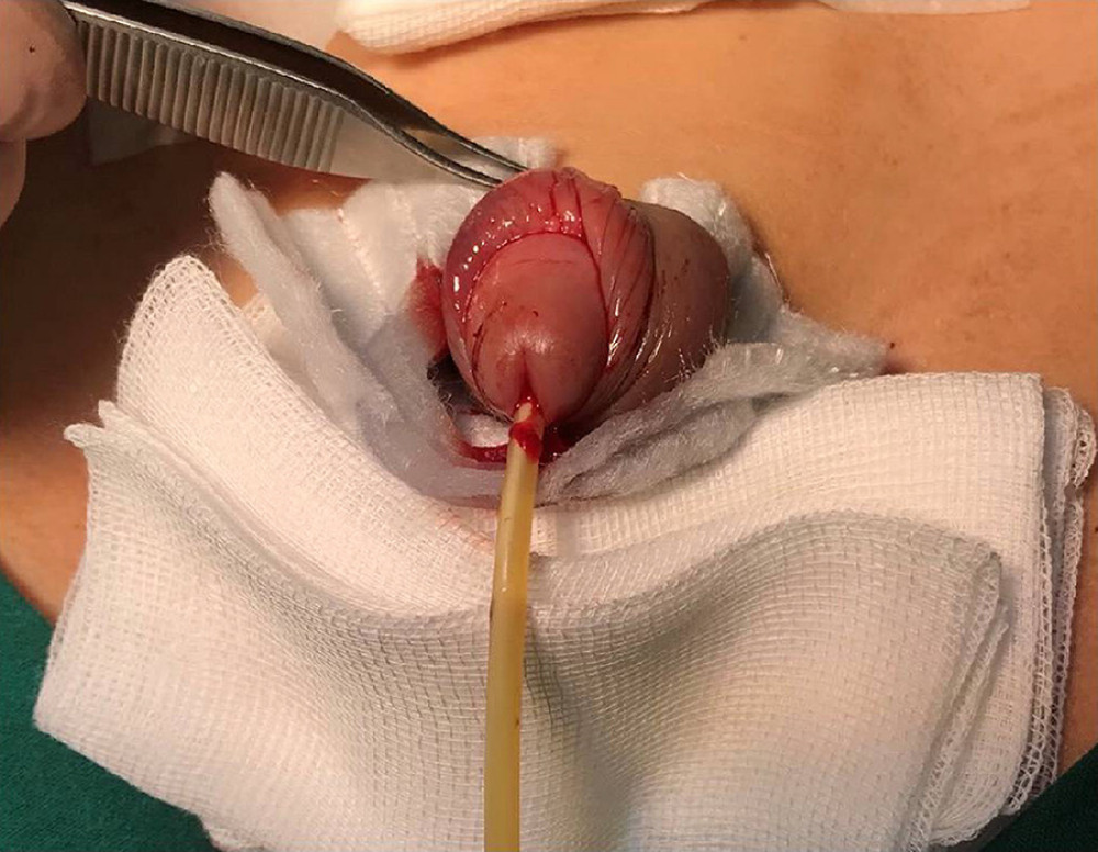 Penile physical condition after microsurgical replantation.