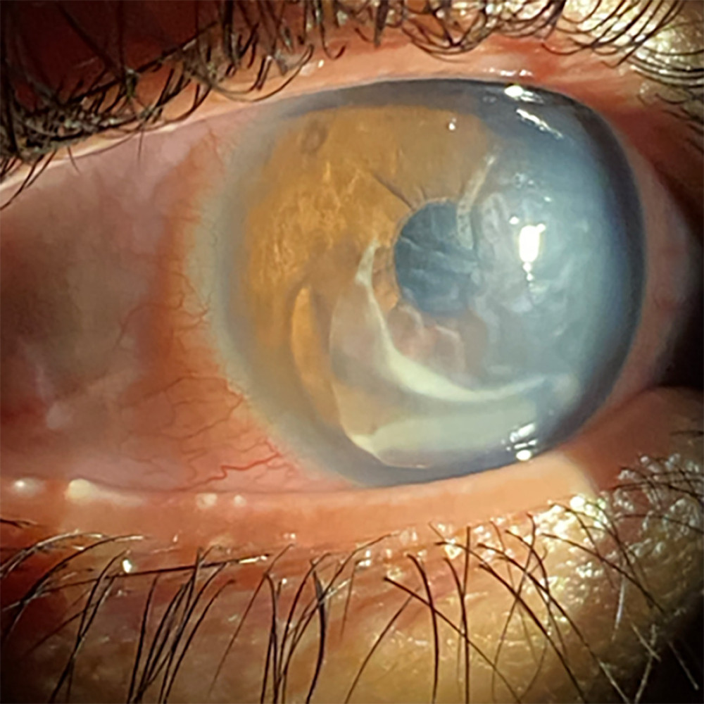 A slit-lamp photo showing corneal edema and a peripheral ring of opacified lens material floating in the anterior chamber.
