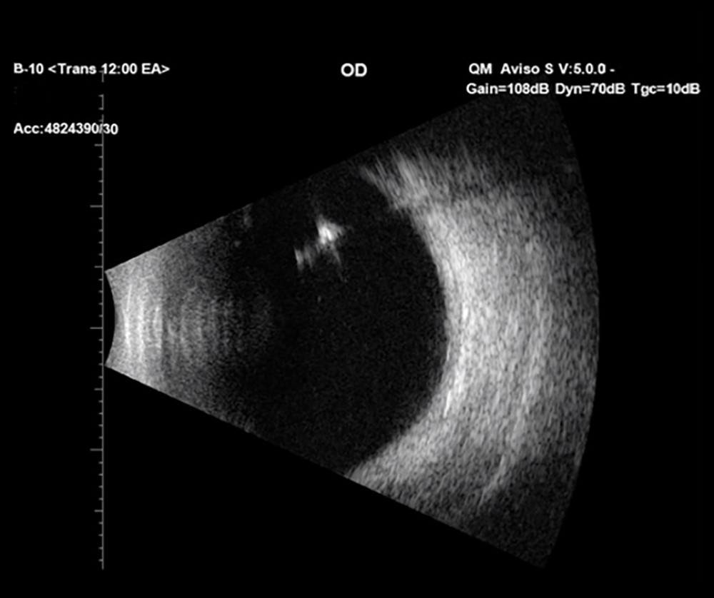 B-scan ultrasonography showing highly reflective material in the vitreous cavity corresponding to the migrated segment of dislocated Sömmering ring and a flat retina.