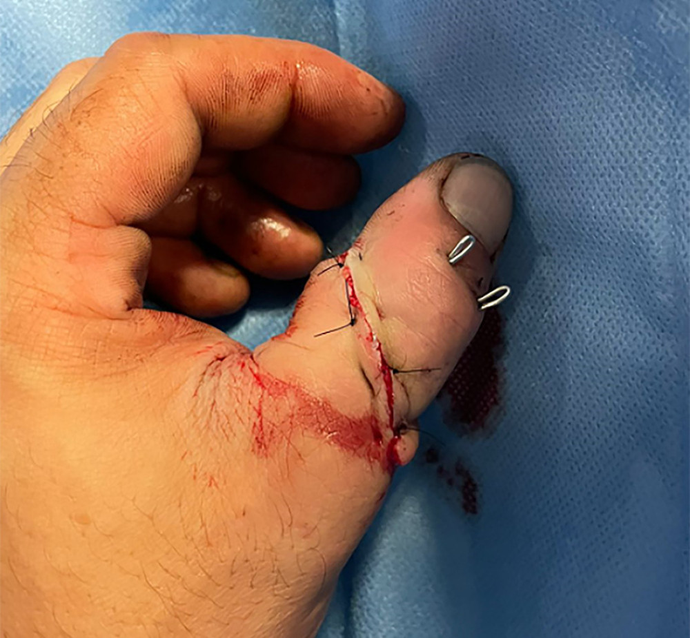 Appearance of the finger immediately after the arteriovenous anastomosis, with pink color and positive refill test.