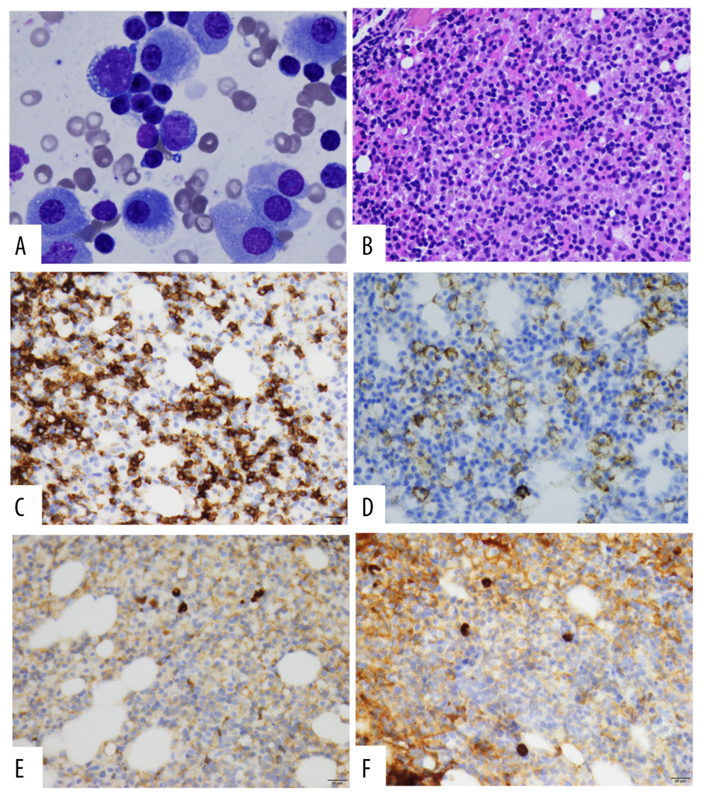 Bone marrow involvement by lymphoplasmacytic lymphoma. (A) Bone marrow aspirate showing many neoplastic plasma cells with abundant cytoplasm mixed with mature small neoplastic lymphocytes. (B) Bone marrow biopsy showing a hypercellular marrow infiltrated by numerous lymphoplasmacytic cells in an interstitial pattern (40×). (C–F) Immunohistochemical stains: B cells highlighted by CD20 (C) and plasma cells by CD138 (D) that lack significant expression of kappa (E) or lambda (F).