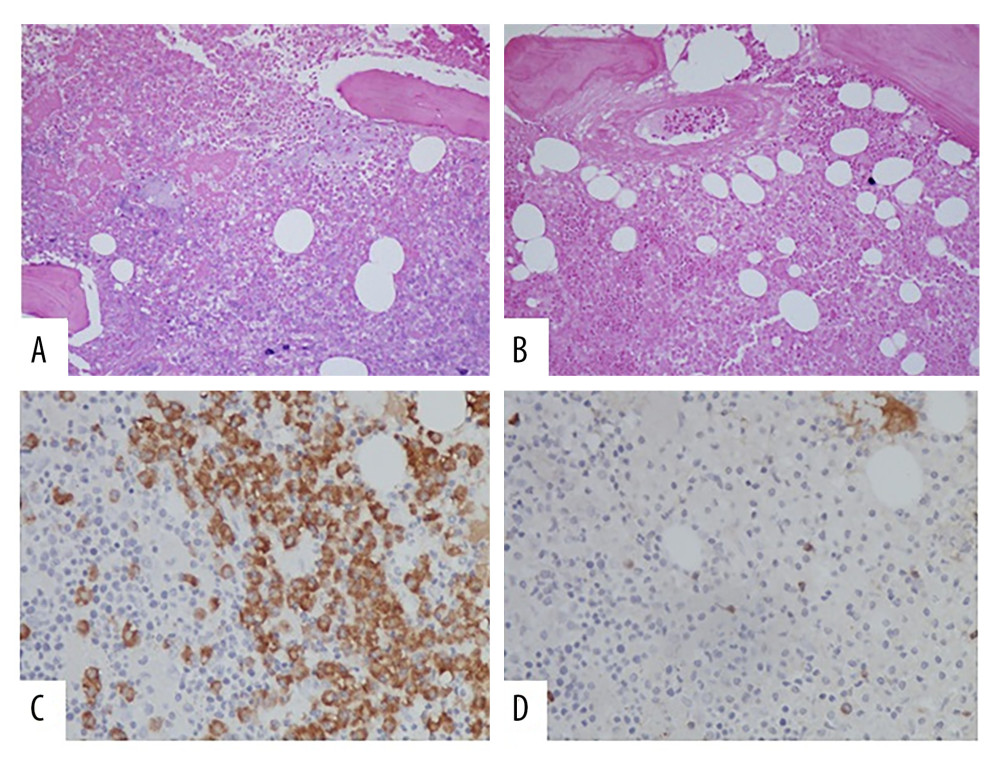Bone marrow showing involvement by lymphoplasmacytic lymphoma. In situ hybridization for kappa (A) and lambda (B) demonstrating lack of light chain expression by neoplastic infiltrate. Immunohistochemistry highlighting the neoplastic plasma cell that express IgA (C), while lacking IgM (D).