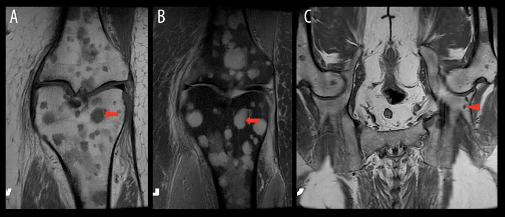 (A–C) A 60-year-old woman presented due to left knee and calf pain, subsequently found to be caused by ECD. (A, B) MRI of the left knee showing innumerable T1-dark (A) and proton-density-bright (B) marrow-replacing lesions throughout the distal femur, proximal tibia, and proximal fibula (example lesion denoted by arrows). The patient also had small meniscal tears of the knee. (C) Follow-up MRI of the pelvis demonstrating additional lesions (arrowhead).
