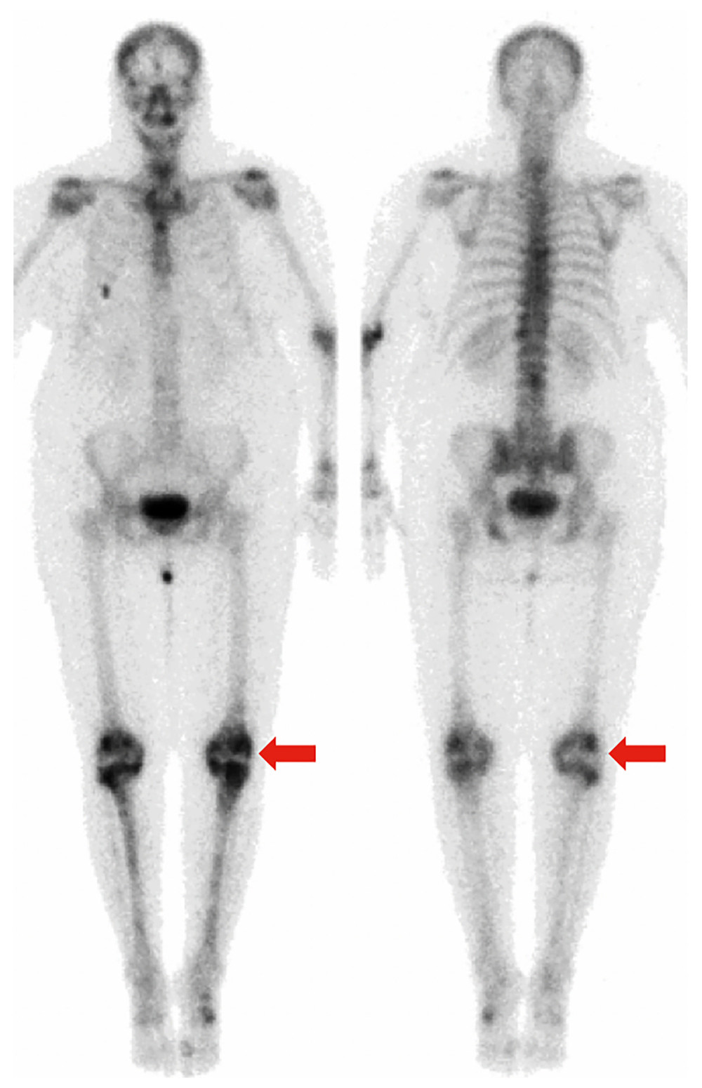 99mTc-MDP bone scintigraphy showing radiotracer uptake in the bilateral knees suggestive of degenerative changes (arrows). There is no radiotracer uptake in the pelvis or proximal femur corresponding to the lesions visualized on MRI.