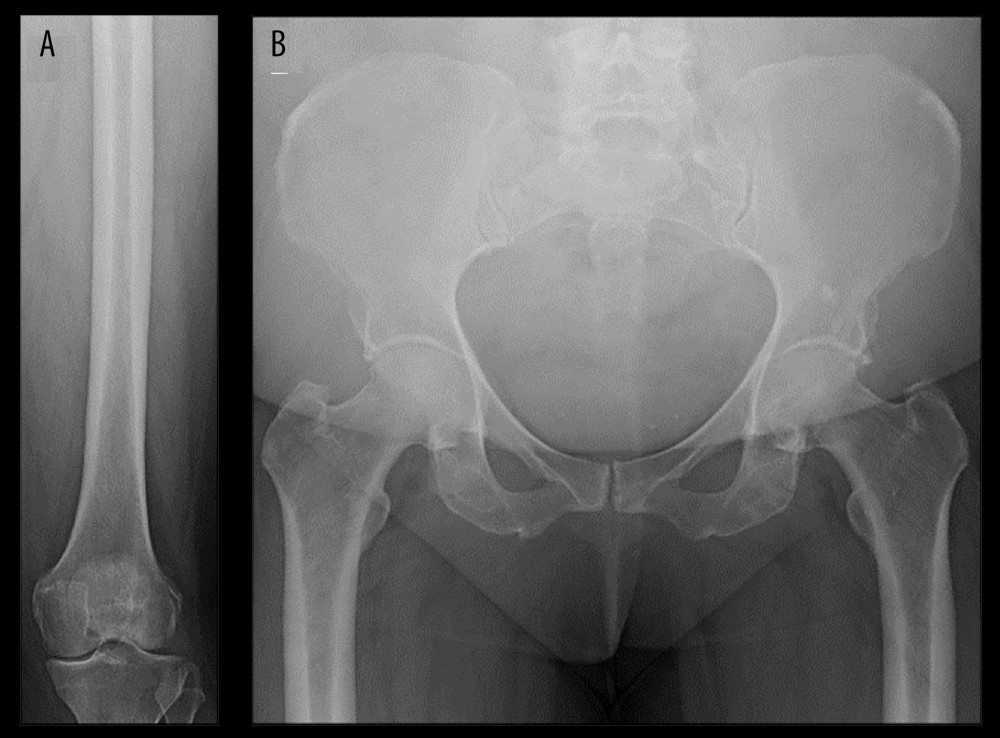 (A, B) Radiographs of the knee (A) and pelvis (B) showing no evidence of the lesions visualized on MRI.
