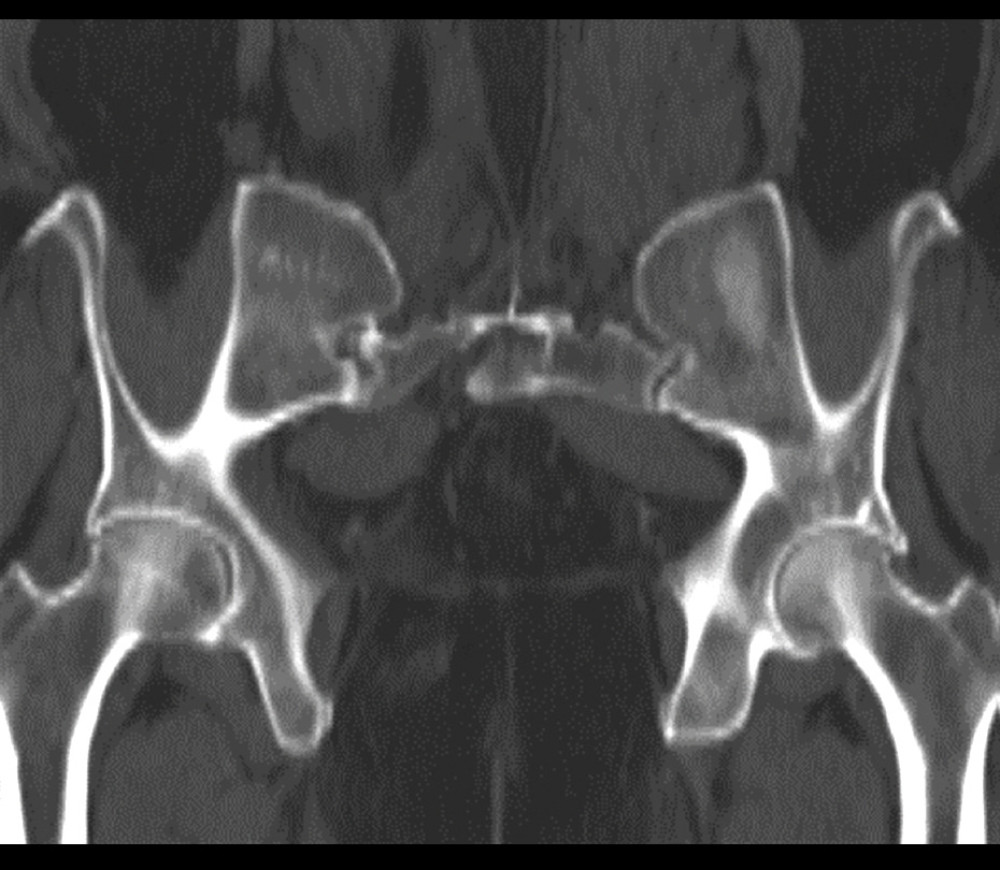 CT scan of the pelvis showing no evidence of the lesions visualized on MRI.
