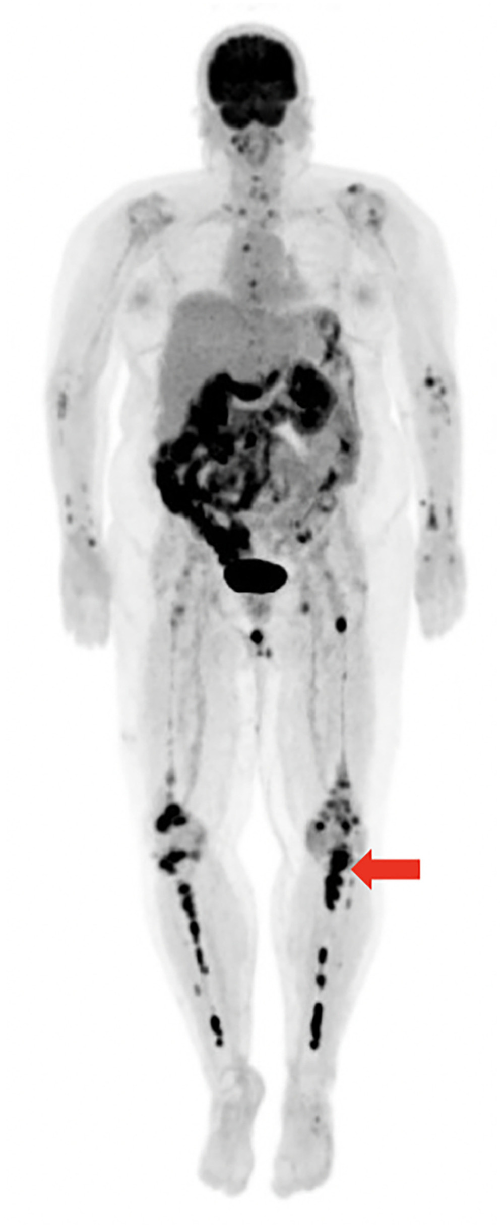 PET/CT scan showing innumerable foci of 18F-FDG-avid lesions throughout the axial and appendicular skeleton (example lesion denoted by arrow).