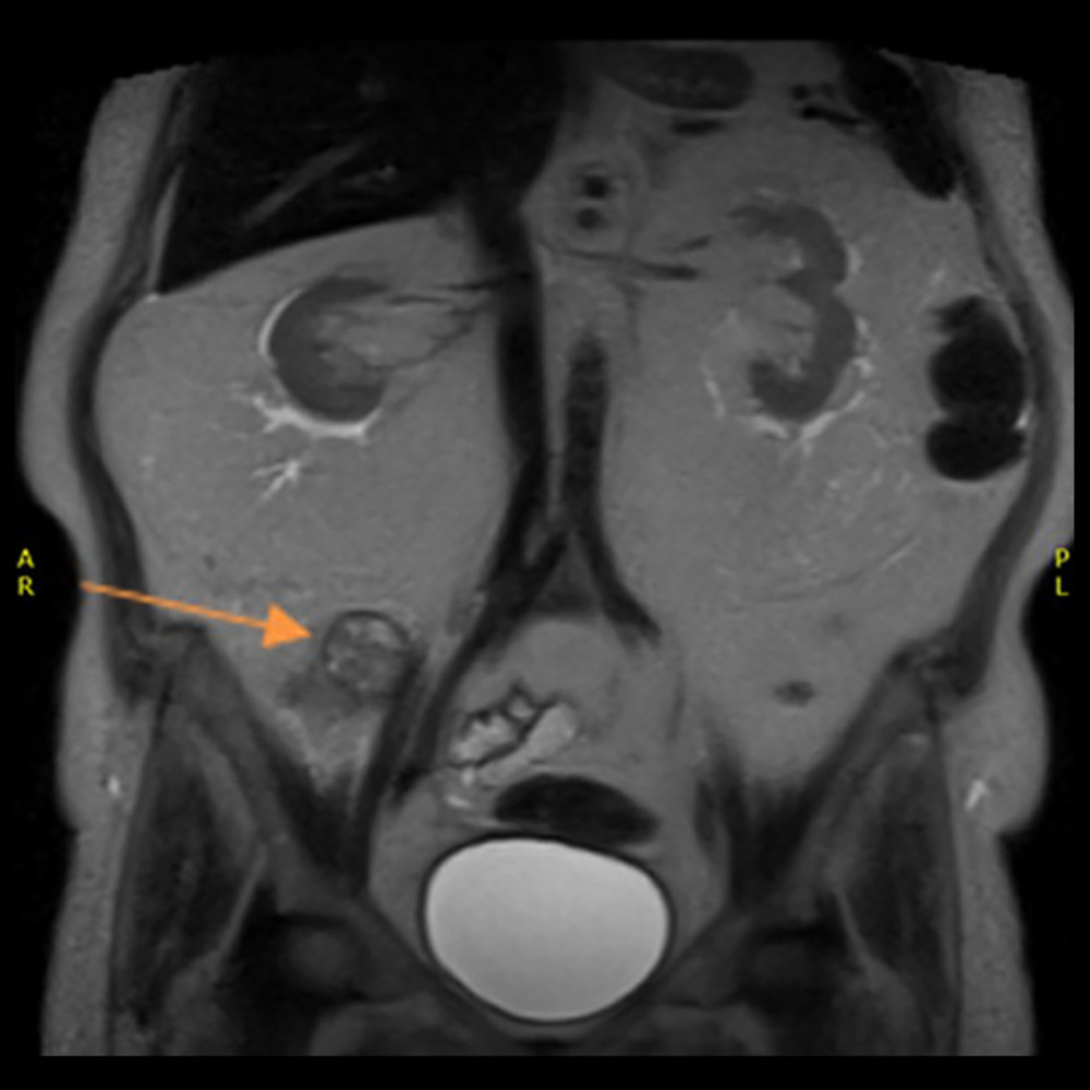 Coronal T2 image (Haste) mass in right upper pole of transplanted kidney (arrow).