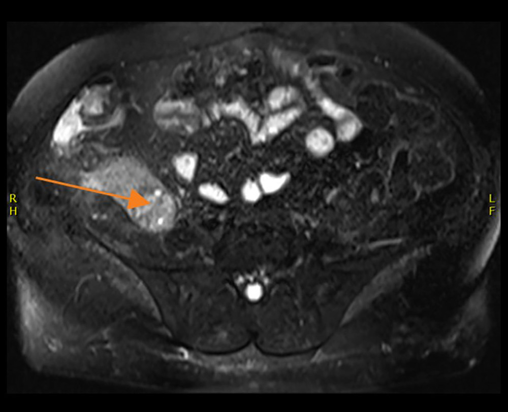 Axial T2 image, lesion at upper pole of transplanted kidney (arrow).