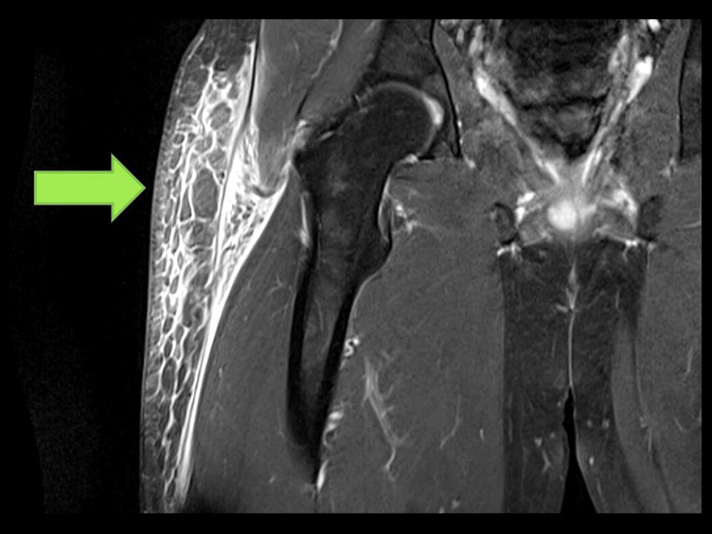 Magnetic resonance imaging with contrast of right hip: severe intramuscular edema and enhancement within the right tensor fascia lata and mild intramuscular edema within the right gluteus medius, right gluteus minimus, and right gluteus maximus, concerning for severe myositis versus myofascial soft tissue infection.