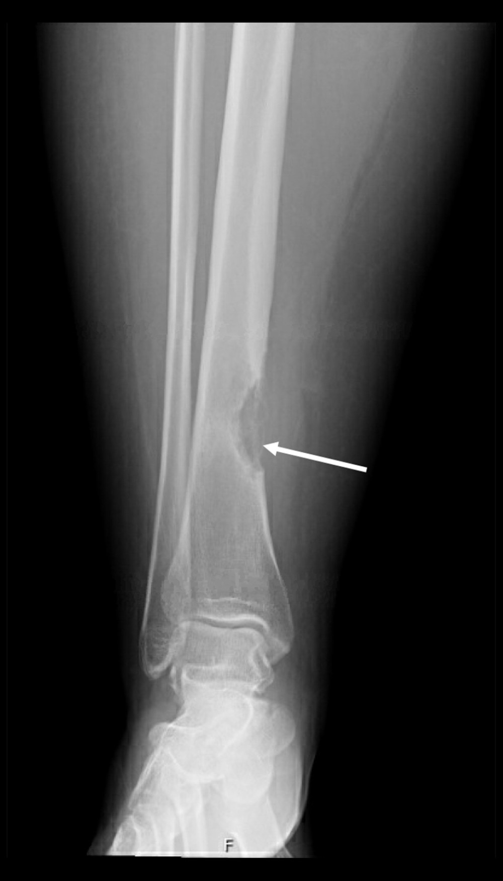Destructive bone lesion noted at the distal tibial medial cortex with the “shark bite” appearance (arrow) and extending into the soft tissue with calcific focus posteriorly.