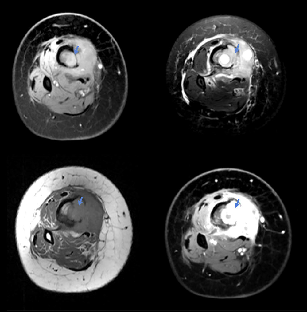 Multiplanar, multi-sequential magnetic resonance imaging scan of the right femur and tibia showing in distal cuts a bone tumor (arrows).